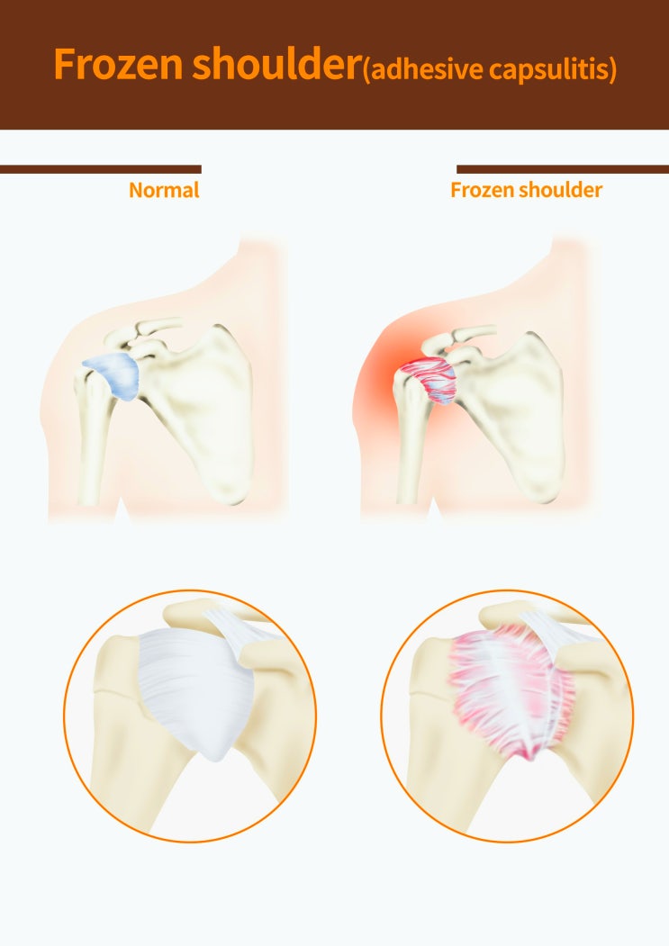 오십견 치료 병원, 딱 1가지만 살펴보세요.