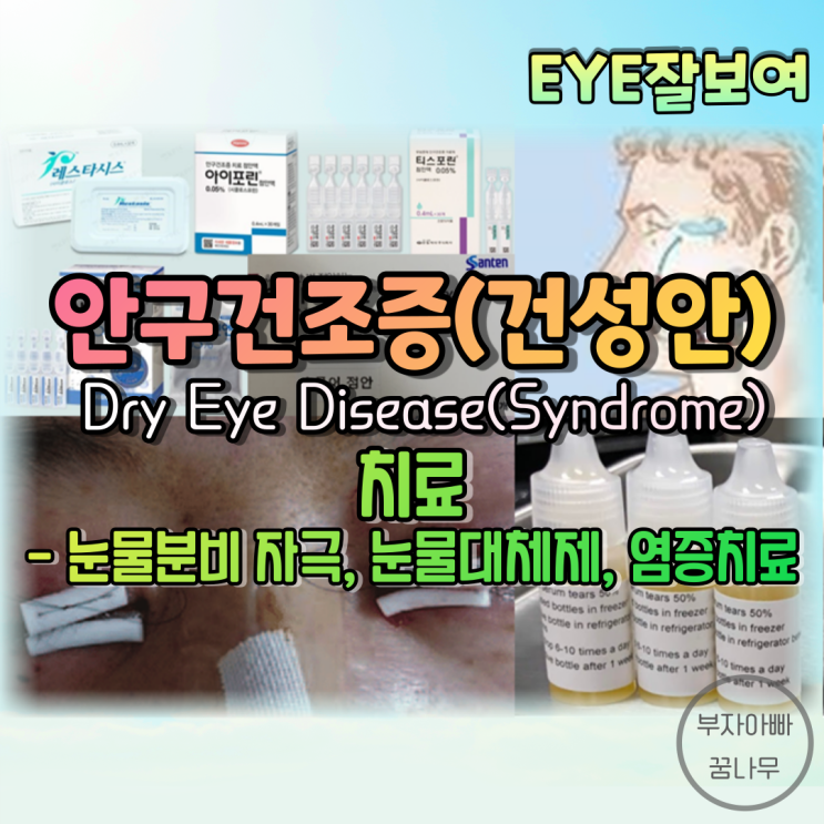 [EYE잘보여] 안구건조증, 건성안(Dry Eye Disease, Dry Eye Syndrome) (4) - 치료: 눈꺼풀봉합, 눈물분비 자극, 눈물대체제; 자가혈청 , 염증치료