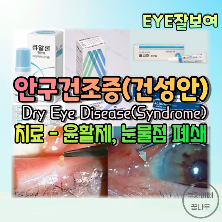 [EYE잘보여] 안구건조증, 건성안(Dry Eye Disease, Dry Eye Syndrome) (3) - 치료: 윤활제(인공눈물, 눈물연고, 겔), 눈물점 마개, 눈물점 수술