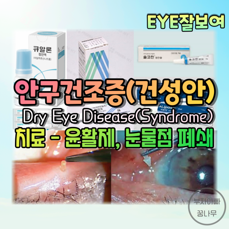  [EYE잘보여] 안구건조증, 건성안(Dry Eye Disease, Dry Eye Syndrome) (3) - 치료: 윤활제(인공눈물, 눈물연고, 겔), 눈물점 마개, 눈물점 수술