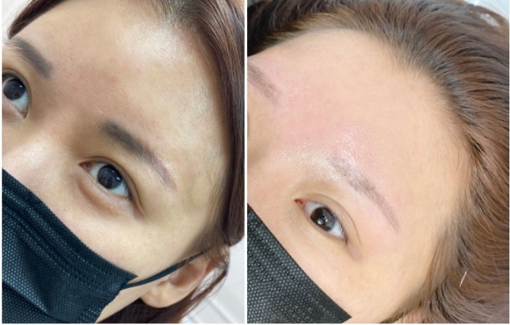 누니아 눈썹 / 금천구 눈썹, 눈썹문신제거로 붉고 검은 잔흔들 제거하고 왔어요(날짜별 사진까지)