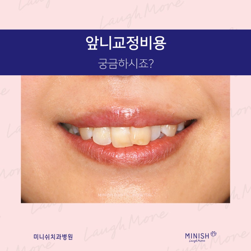 대구 치열교정 전후 후기 덧니교정 비용의 가격은? 4