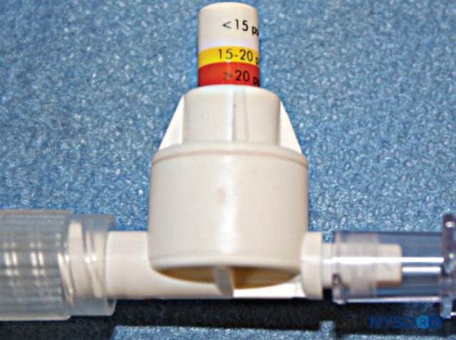 신경내주사 진단 방법- 압력 측정(injection pressure monitoring) ; 말초신경차단술(peripheral nerve block)-(4)