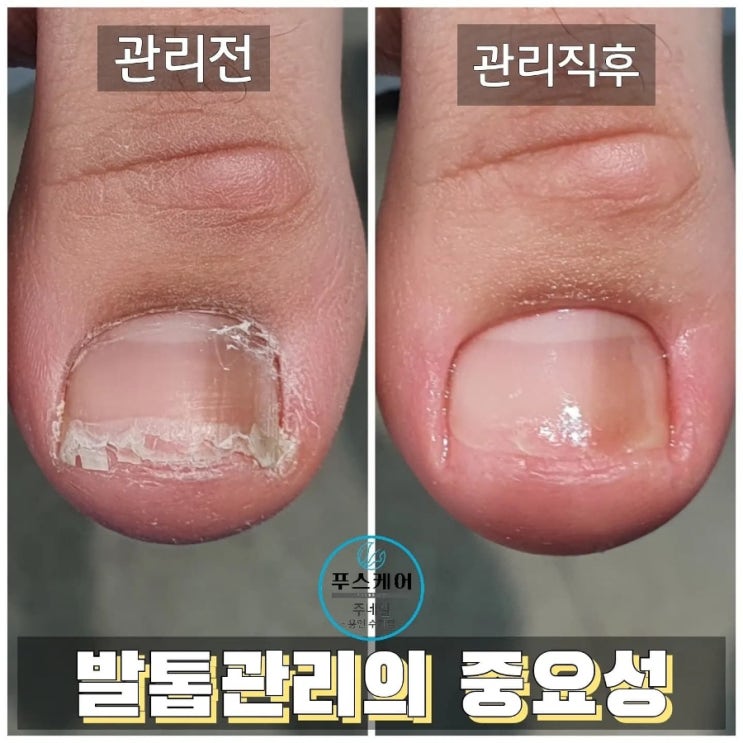 부서지고 깨지는 발톱 기본케어만 했는데 몰라보게 달라졌어요. /성남수원수지보정동백죽전동/주네일/무좀파고드는내향성발톱손톱변형전문점 부서지고 깨지는 발톱 기본케어만 했는데 몰라보게 달라졌어요. /성남수원수지보정동백죽전동/주네일/무좀파고드는내향성발톱손톱변형전문점