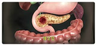  췌장암 원인위험요인 증상징후 췌장절제술예후경과 항암치료 생존사망율 황달당뇨합병증 간호진단과정