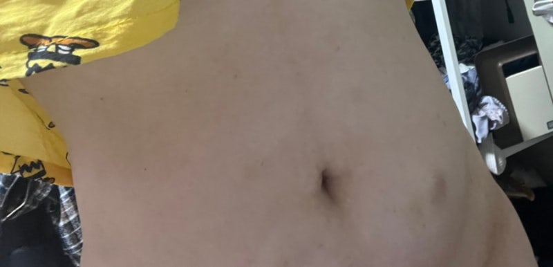 2.5kg감량 후 복부지방용융주사 효과 3