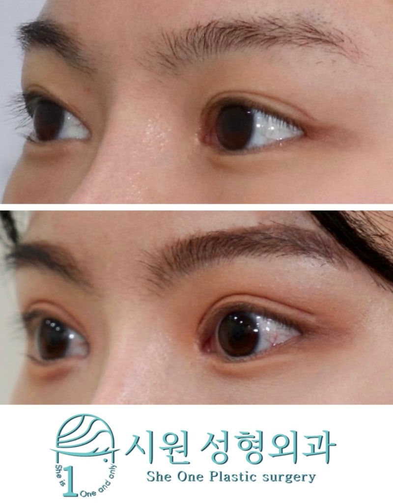 70 쌍꺼풀 풀림과 소시지눈을 개선하는 절개법쌍꺼풀 재수술 5개월차 경과, 후기 by 시원성형외과 : 네이버 블로그, image size:800x1026