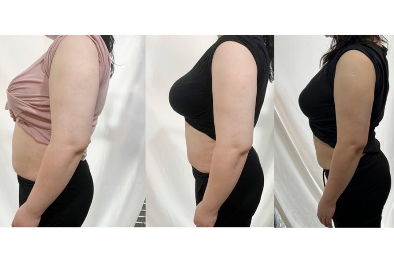 2.5kg감량 후 복부지방용융주사 효과 2