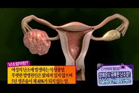  난소암 원인증상특징 절제수술생존율 항암치료 암전이진행 양성악성 난소암예후경과합병증 간호진단