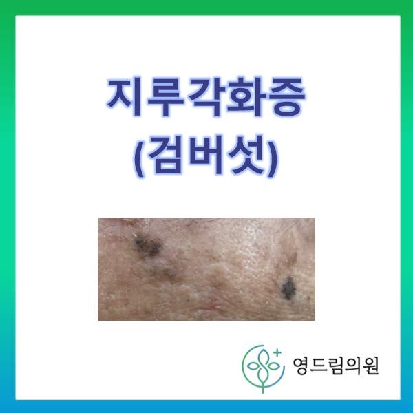 지루각화증(흑버섯)의 원인과 증상, 예방, 치료방법 3