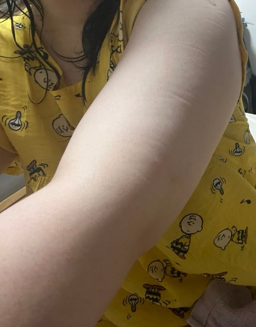 2.5kg감량 후 복부지방용융주사 효과 6