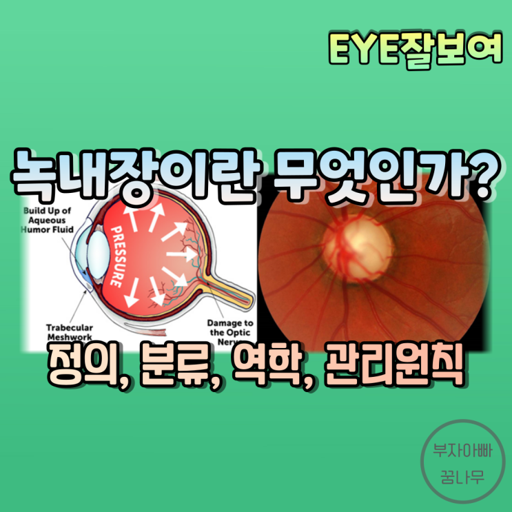  [EYE잘보여] 녹내장이란 무엇인가? - 녹내장의 개요: 정의, 분류, 역학적 특성, 위험인자, 관리