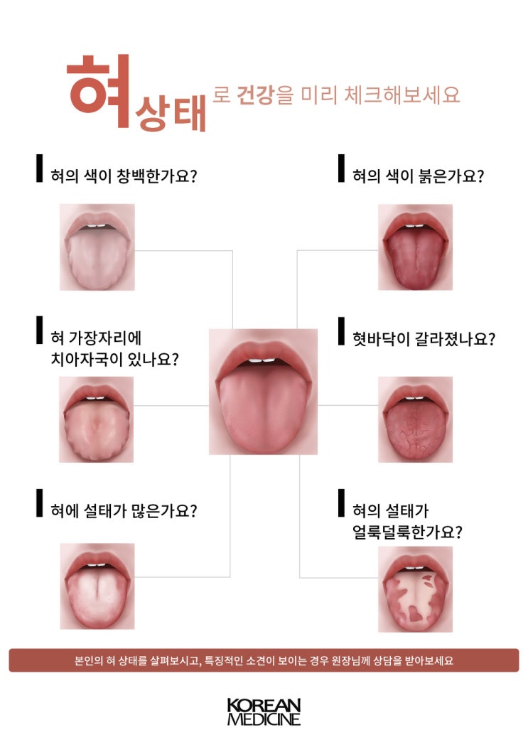 설태와 치흔으로 보는 혀가 알려주는 건강상태