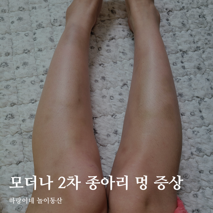  수유부 코로나백신 모더나 2차 종아리 멍듬
