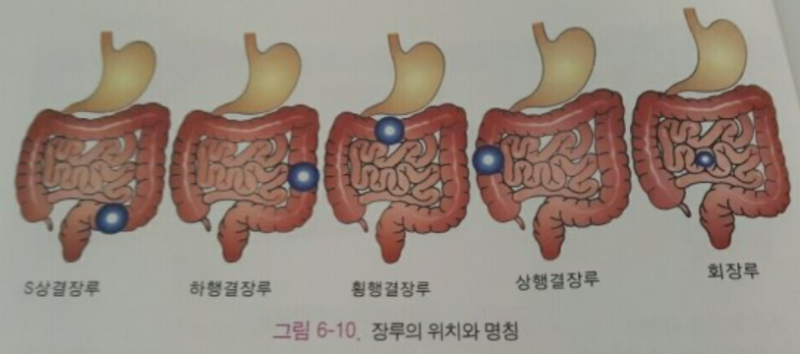 내과간호사가 알려주는 [장루의 종류와 특징] : 네이버 블로그