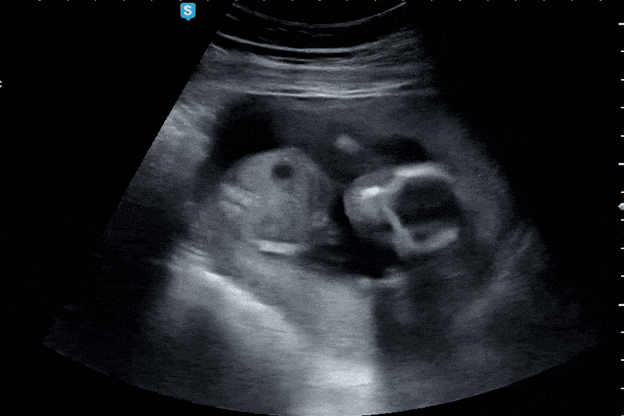 임신 16주차, 성별 확인