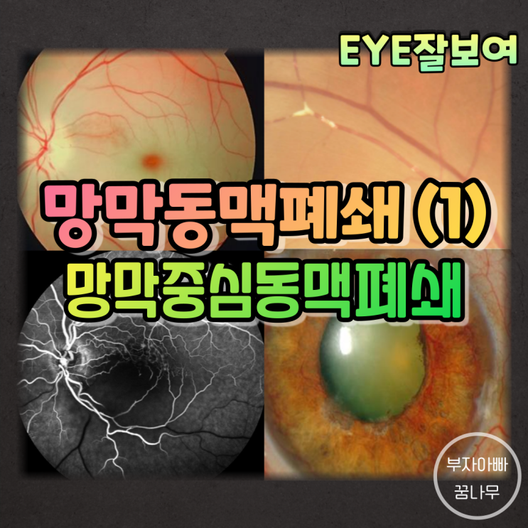  [EYE잘보여] 망막동맥폐쇄 (1) - 망막중심동맥폐쇄(Central Retinal Artery Occlusion; CRAO): 원인, 증상, 임상소견,  검사, 진단, 치료