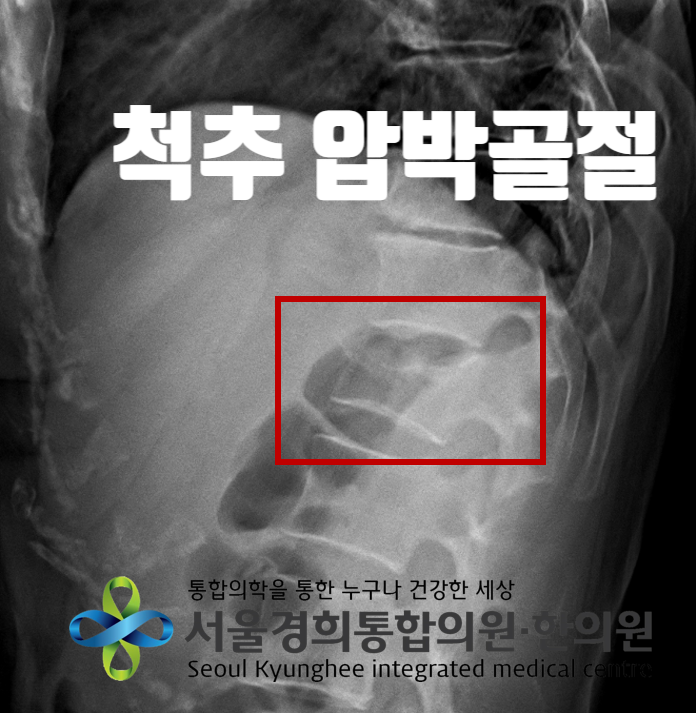 척추압박골절, 단순 미끄러짐에 주의해야 하는 이유 6