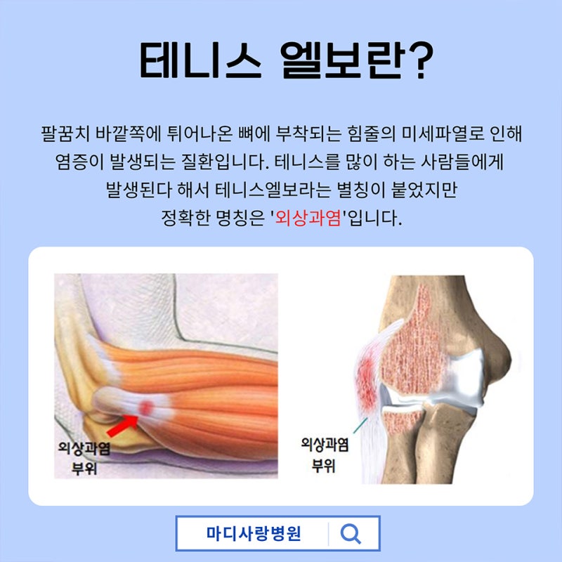 외상과염, 요골신경 이용한 테니스 팔꿈치 증상 치료 2