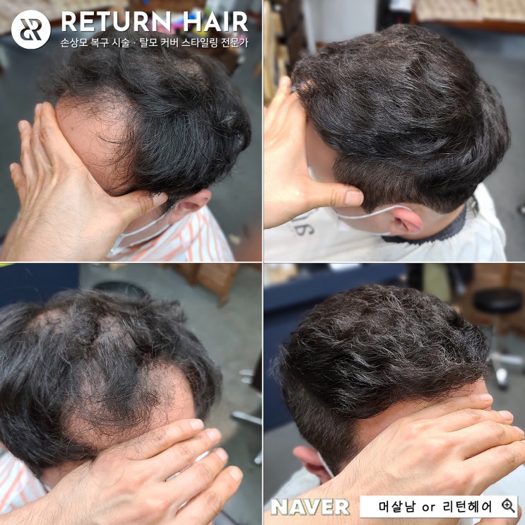  정수리 탈모로 잃어버린 젊음을 되찾는 남자 탈모펌, 수원 권선구청에서 오셨어요.