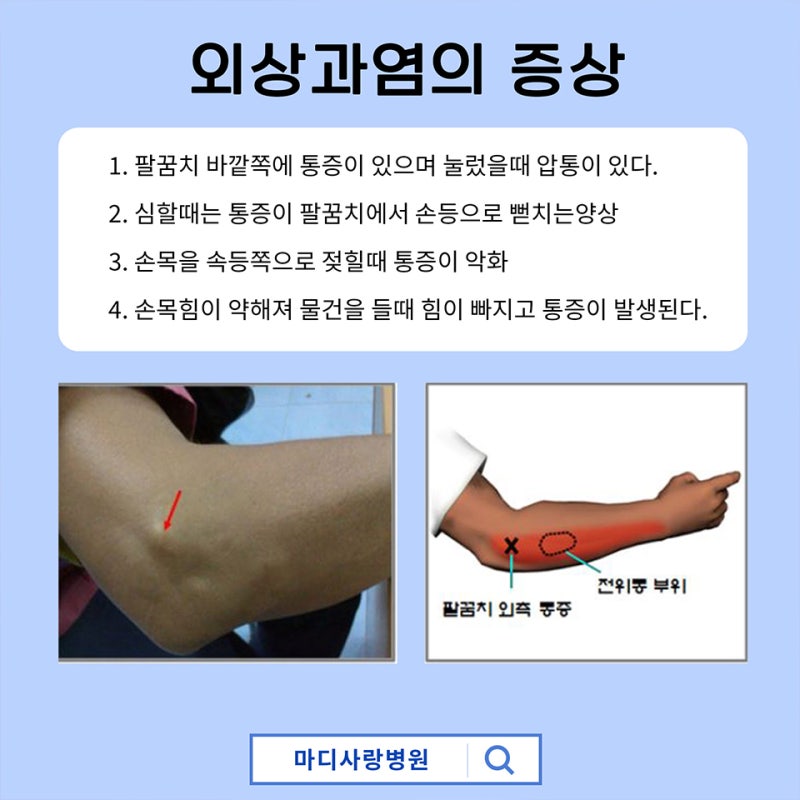 외상과염, 요골신경 이용한 테니스 팔꿈치 증상 치료 5