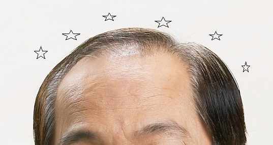  여성형 탈모, 남성형 탈모 모두 사용되는 미녹시딜, 바를까? 먹을까?