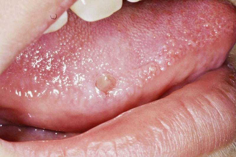 혓바늘 원인과 혓바늘 없애는법 : 네이버 블로그