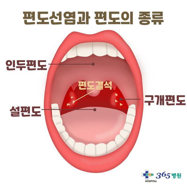  [창원마산 척추관절 디스크 365병원] 편도선염