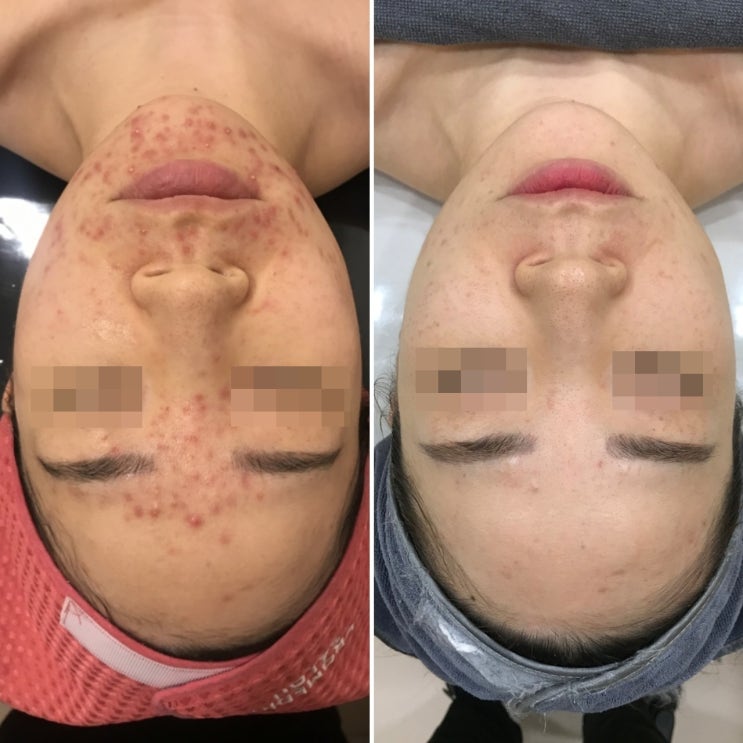  신림피부관리실 지루성피부염 여드름피부관리 압출잘하는곳 하이스킨
