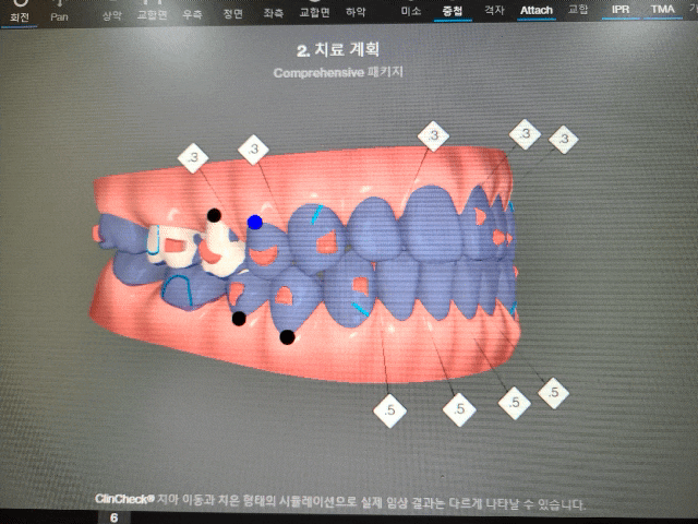 투명교정으로 재치료 받는 교정 전문 치과의사(feat. 인비절라인), 하남 인비절라인 치료 전문의 투명교정으로 재치료 받는 교정 전문 치과의사(feat. 인비절라인), 하남 인비절라인 치료 전문의