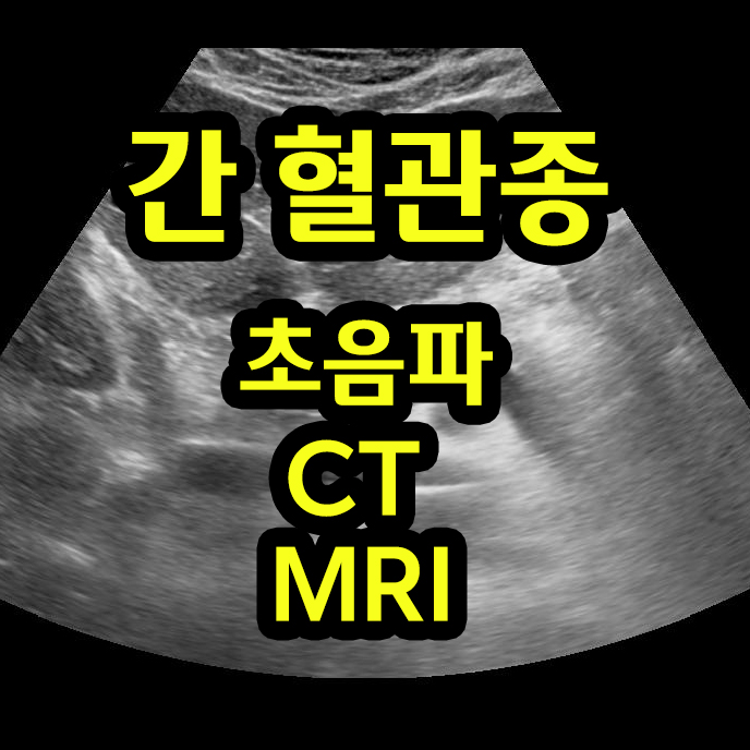  간 혈관종 검사 소견들(초음파, CT, MRI)
