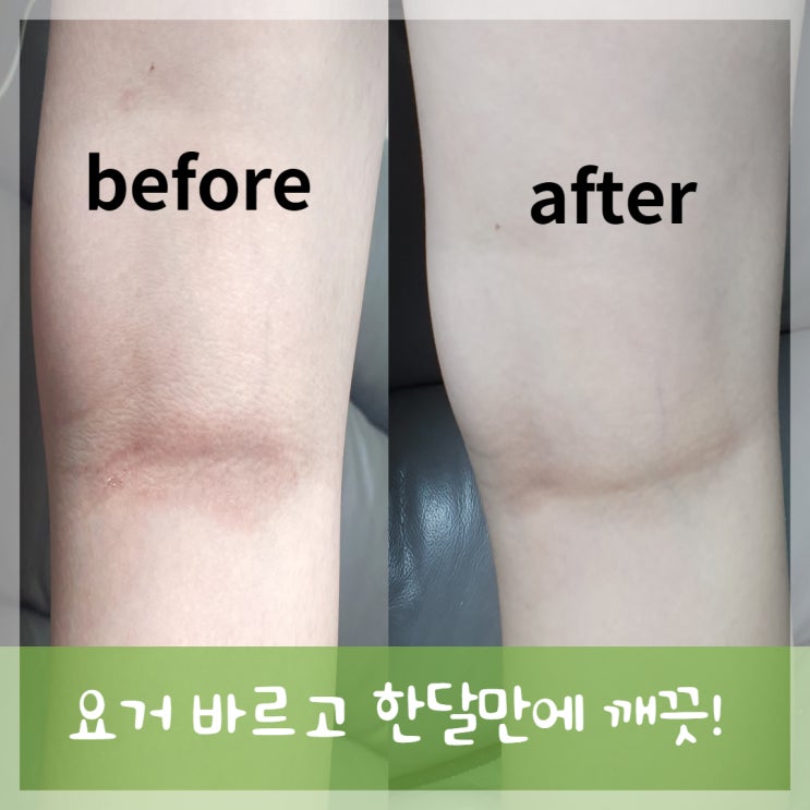 우리아이 #가려움 #착색 #락티케어 before & after