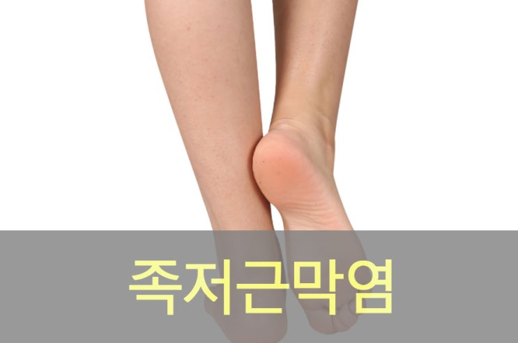  족저근막염의 증상 원인, 통증, 예방, 스트레칭, 영양제