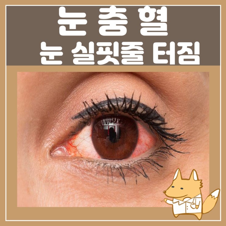 한쪽 눈 충혈 원인 : 눈 간지러움 따가움, 눈 실핏줄 터짐 결막하출혈, 왼쪽 오른쪽 눈통증
