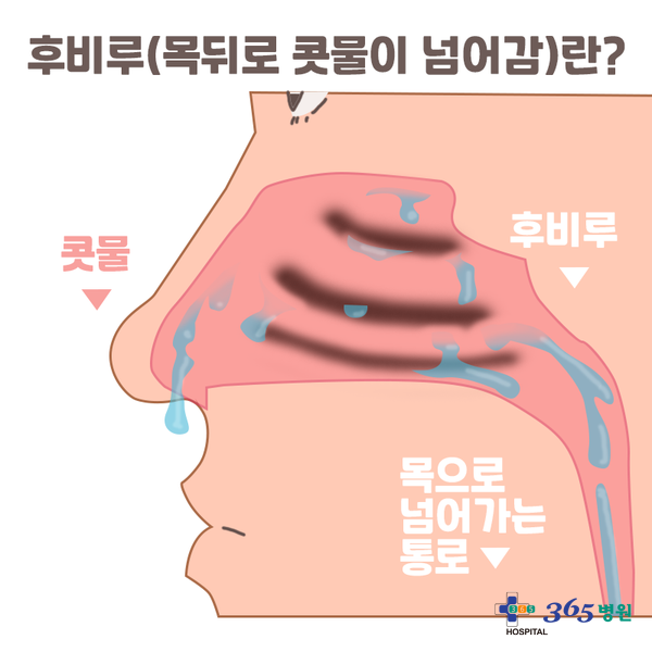  [창원마산 척추관절 디스크 365병원] 후비루(콧물이 목으로 넘어감)