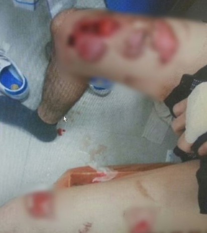 불판 실명 보험금 노린 여동생 부부 잠적 궁금한이야기Y 불판 실명 보험금 노린 여동생 부부 잠적 궁금한이야기Y