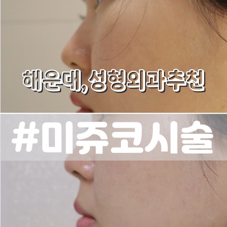 [부산 해운대 성형외과추천] 콧대필러대신 자연스러운 코끝 미쥬코 시술전후 비교!!