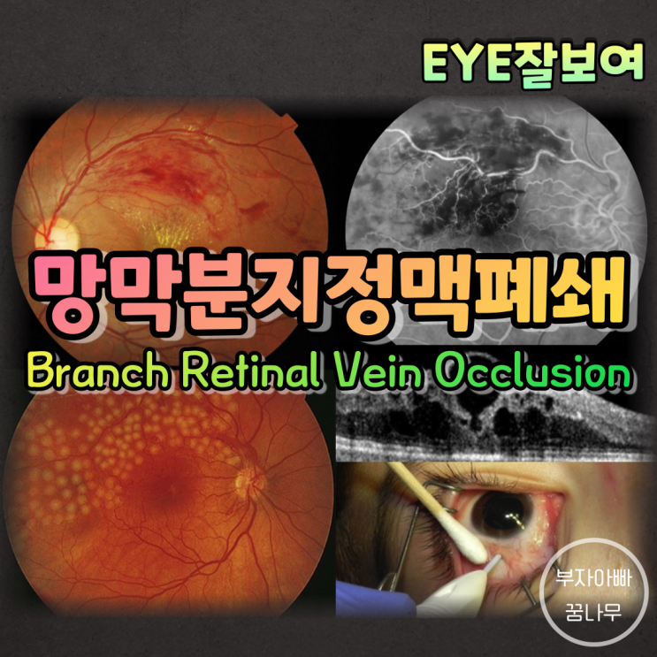 [EYE잘보여] 망막분지정맥폐쇄(Branch Retinal Vein Occlusion; BRVO) - 발생기전(원인), 임상양상, 증상, 소견, 진단, 치료