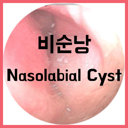  [코] 비순낭(Nasolabial cyst)