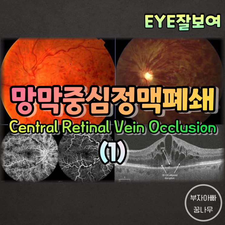  [EYE잘보여] 망막중심정맥폐쇄(Central Retinal Vein Occlusion; CRVO) (1) - 발생기전, 원인, 분류, 역학, 임상양상, 증상, 소견, 진단, 검사