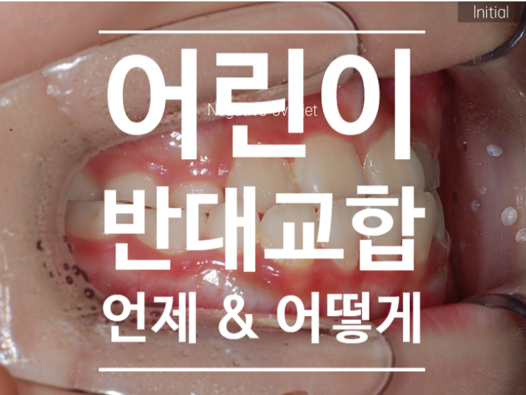 어린이 반대교합 언제, 어떻게 치료하는 게 맞을까?