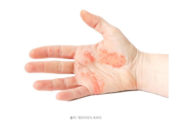  인천한포진 청라손갈라짐 가렵고 아플땐