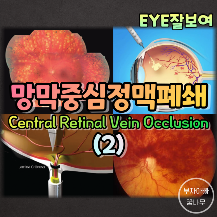 [EYE잘보여] 망막중심정맥폐쇄(Central Retinal Vein Occlusion; CRVO) (2) - 치료, 절반망막중심정맥폐쇄(Hemi-CRVO)