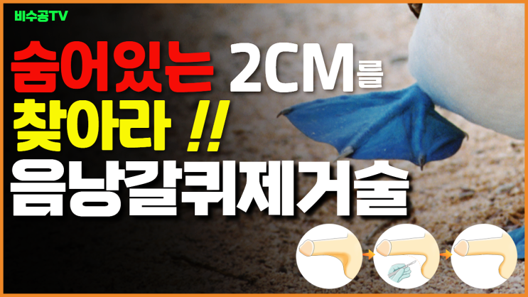 음낭갈퀴제거술, 숨어있는 2cm를 찾아 드립니다. 음낭갈퀴제거술, 숨어있는 2cm를 찾아 드립니다.
