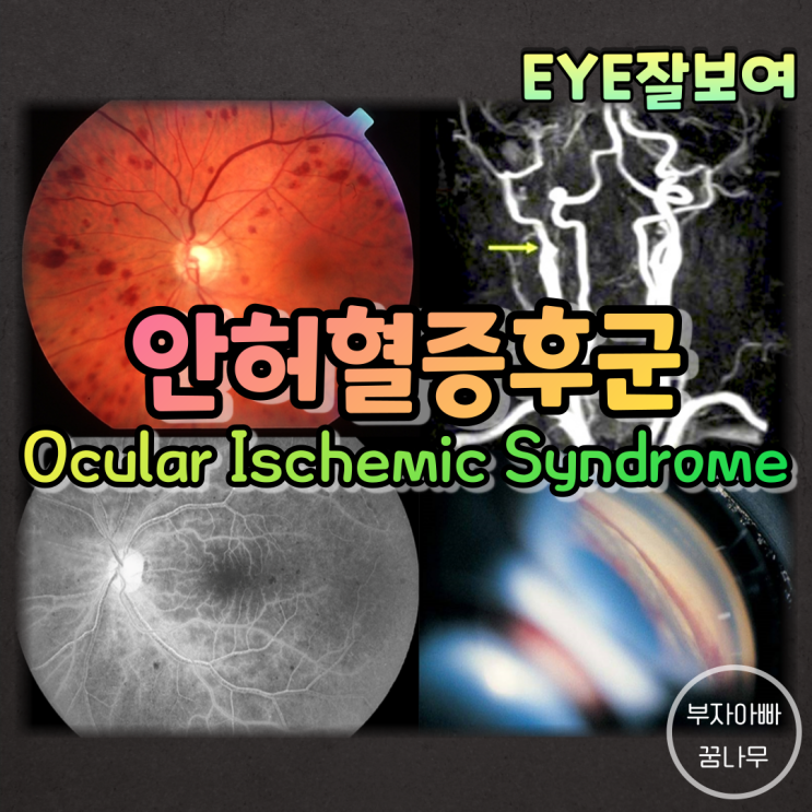  [EYE잘보여] 안허혈증후군(Ocular Ischemic Syndrome; OIS) - 원인, 역학, 증상, 소견, 진단, 검사, 치료