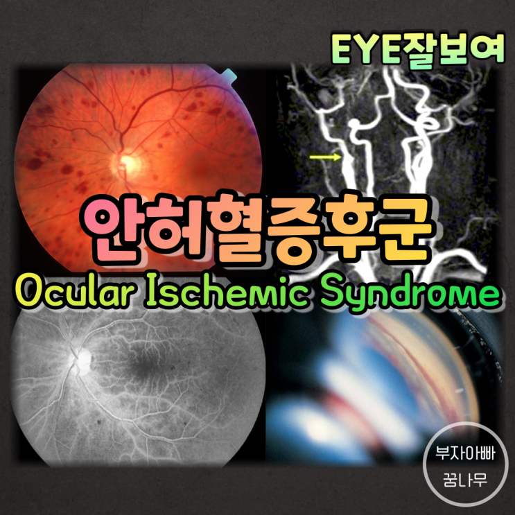 [EYE잘보여] 안허혈증후군(Ocular Ischemic Syndrome; OIS) - 원인, 역학, 증상, 소견, 진단, 검사, 치료