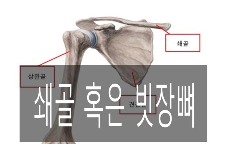 쇄골골절 사례(빗장뼈)