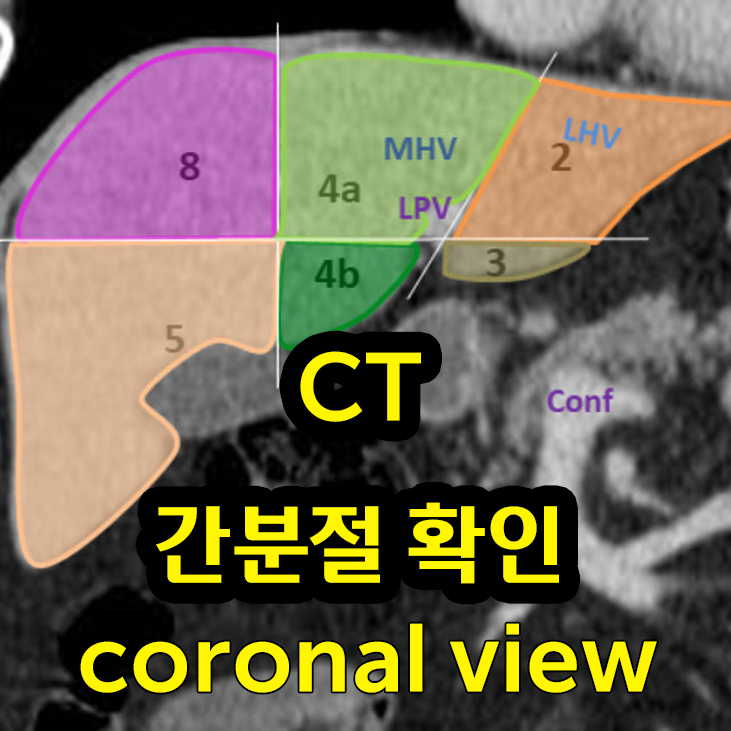  복부CT에서 간분절 구분하기 (coronal view)