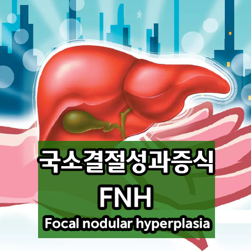  간 국소결절성 과증식 - 양성 간종양 Focal nodular hyperplasia of liver