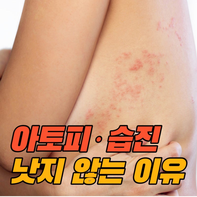 아토피 흉터를 치료하는 방법 8